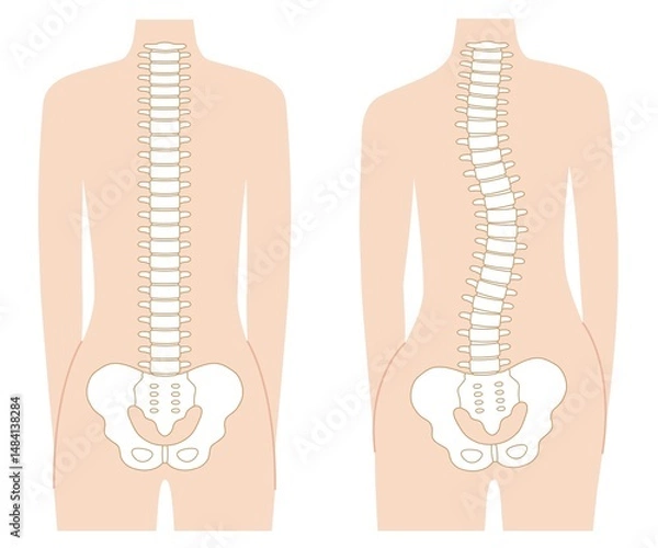 Obraz 背骨の歪み　正常な背骨　