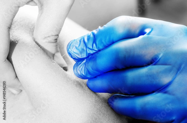 Fototapeta Needle and hands of physiotherapist doing a dry needling in silhouette studio on white background.