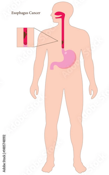 Obraz Human silhouette showing esophagus cancer with highlighted tumor section in digestive tract