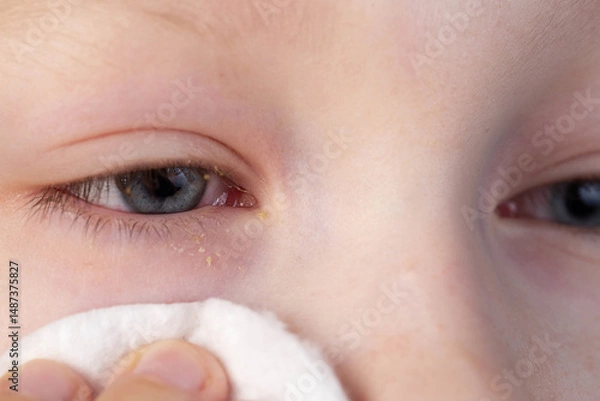 Fototapeta A girl wipes her eyes with a cotton pad to remove pus from her eyes due to conjunctivitis. Bacterial infection, close-up
