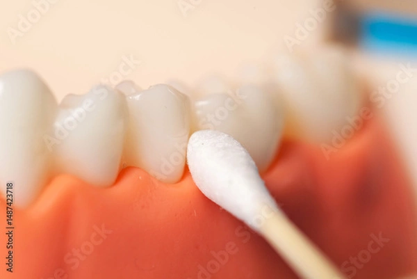 Fototapeta Taking a bacteriological smear from the gingival canal for staphylococci and streptococci bacteria, macro
