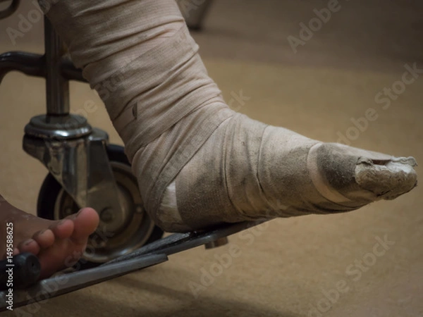 Fototapeta Selective focus at old and dirty splint that wrap on foot bone  fractured. Poor people sit on wheel chair while waiting doctor in public hospital.