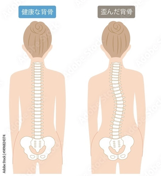 Obraz 歪んだ背骨と健康な背骨　女性