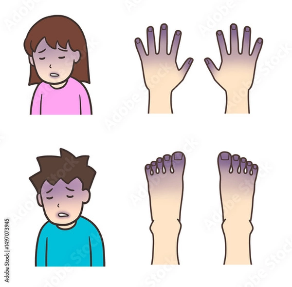 Obraz チアノーゼの視覚的兆候、手足と唇の紫色の変色