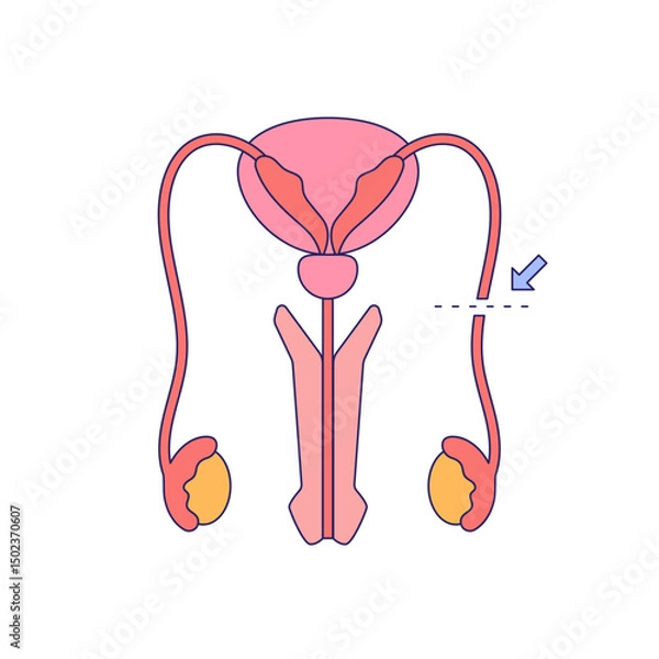 Obraz Vasectomy illustratrion