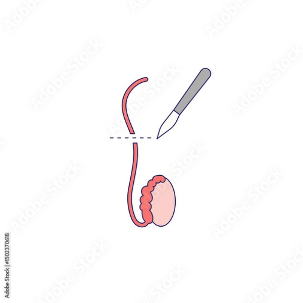 Obraz Vasectomy illustratrion