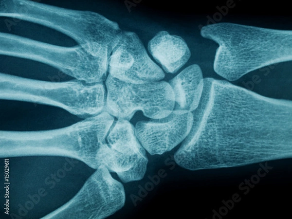 Obraz Hand wrist x-ray