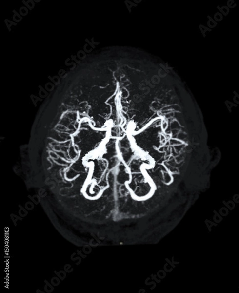 Fototapeta CTA Brain Vascular Imaging , highlights a detailed 3D CTA scan of the brain’s vascular network, showing clear visualization of arteries and blood flow for diagnostic purposes.