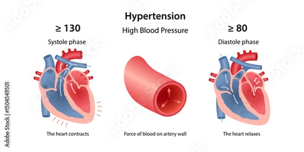 Obraz Hypertension. Medical illustration of high blood pressure. Phases of systole and diastole of heart. Drawing of an artery in section. Vector illustration in flat style isolated over white background