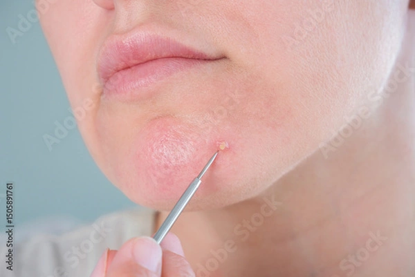 Fototapeta Purulent pimple on a woman's face. A woman uses a skin cleansing tool.