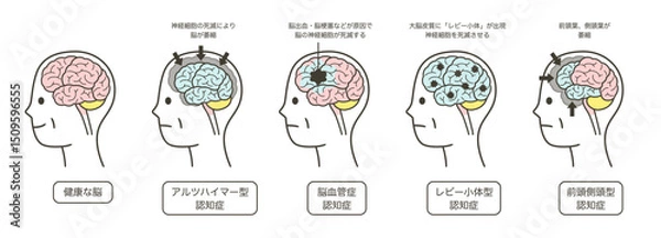 Obraz 高齢者が認知症によって損傷を受ける脳の部分とその名称のイラストのセット
