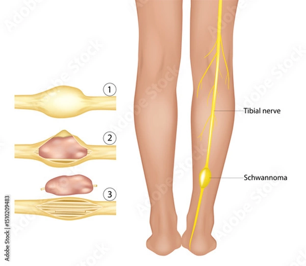 Obraz Tibial Nerve Tumor Anatomy. Peripheral Nerve Sheath Tumor in Leg. Schwannoma Medical Visualization. Detailed medical illustration showing the surgical removal of a benign tumor from a tibial nerve. 