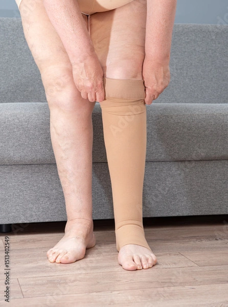 Fototapeta Anonymous woman putting on medical compression underwear on her legs. Stockings to maintain the tone of veins and valves. Prevention of thrombosis