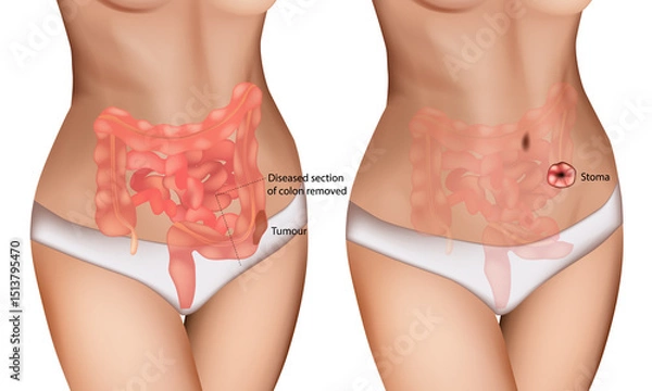 Obraz Colon Cancer Surgery and Stoma Formation Medical Illustration. Digestive Tract Tumor Removal with Colostomy Diagram. Colorectal Tumor Resection and Ostomy Procedure Anatomy