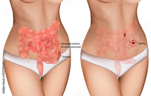 Obraz Colon Cancer Surgery and Stoma Formation Medical Illustration. Digestive Tract Tumor Removal with Colostomy Diagram. Colorectal Tumor Resection and Ostomy Procedure Anatomy
