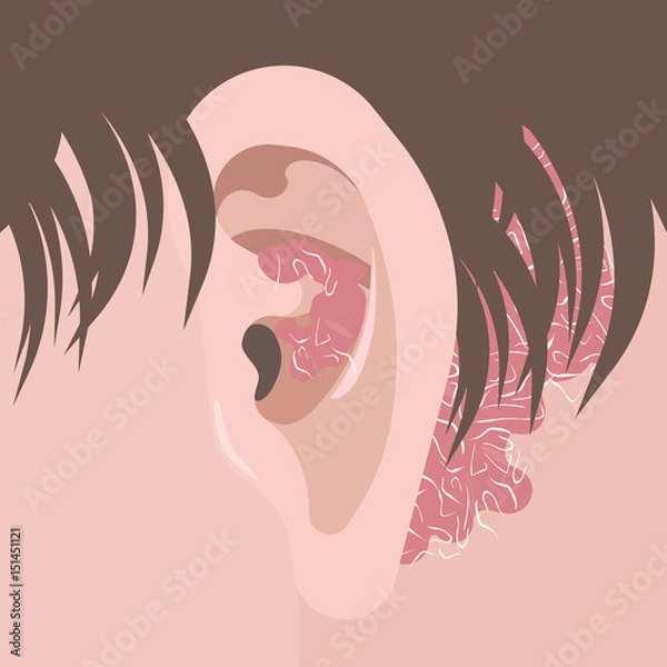 Obraz Human neck and ear with psoriasis