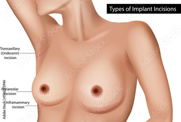 Obraz Breast Implant Incision Types Medical Illustration. Vector Diagram of Breast Surgery Incision Options. Cosmetic Surgery Breast Implant Access Points Labeled