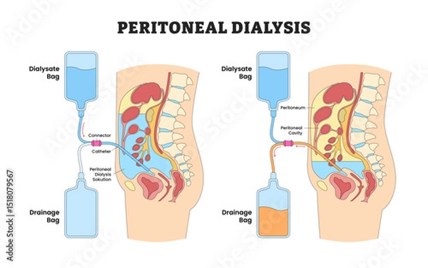 Obraz Peritoneal Dialysis Before After Home Care with Dialysate and Drainage Bag, Educational Medical Poster Design Healthcare Scheme, Labeled Catheter, Peritoneum, Connector, Solution, Cavity.