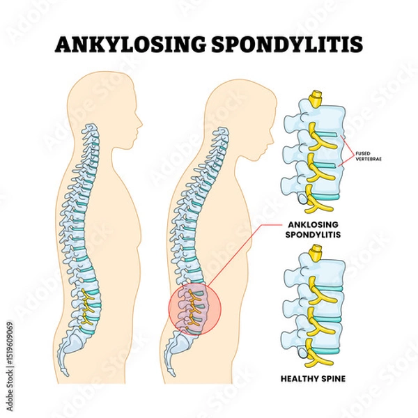 Obraz Ankylosing Spondylitis or Bamboo Spine Spinal Disease, Educational Medical Poster Design Healthcare Scheme, Labeled Fused Vertebrae, Human Chronic Inflammation Backbone Structure Anatomy.