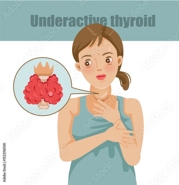 Fototapeta Illustration of Woman with Thyroid Problem