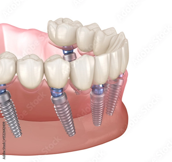 Fototapeta Mandibular prosthesis on 6 system supported by implants, screw fixation. 3D illustration