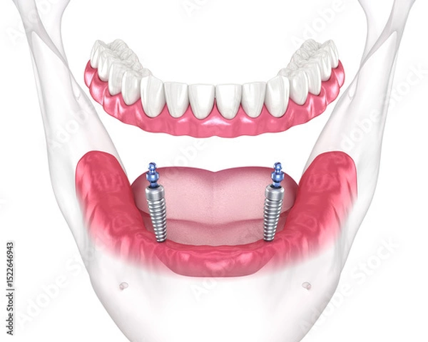 Fototapeta Mandibular removable prosthesis All on 2 system supported by implants with ball attachments. Medically accurate dental 3D illustration