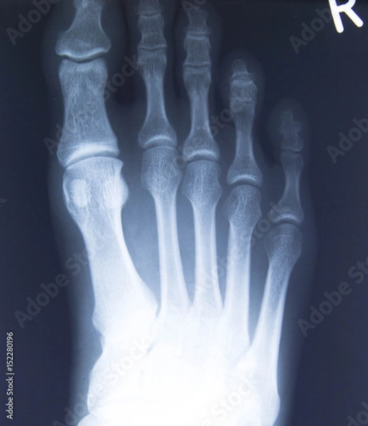 Obraz Rötgenaufnahme der Fußzehen, recht