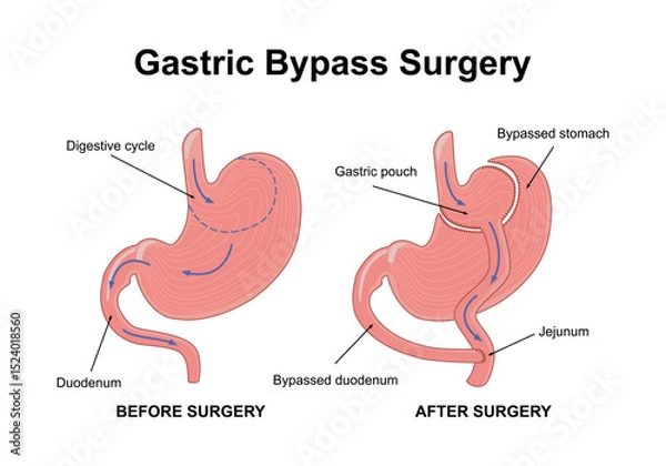 Obraz Gastric bypass gastroplasty stomach operation. Human organs before and after surgery. Obesity problem, weight loss procedure. Abdomen laparoscopy medical poster. Overweight problem vector illustratio