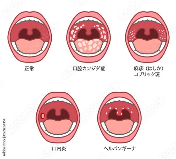 Obraz 口腔内にできる症状のイラストセット