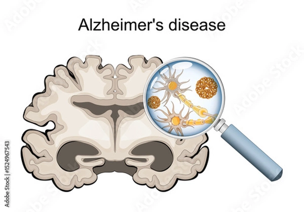 Fototapeta Alzheimers disease. microscopic view of neurons showing neurofibrillary tangles and amyloid plaques
