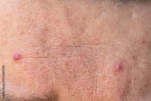 Obraz Skin problems. European male forehead with acne and pimples. Macro close up shot