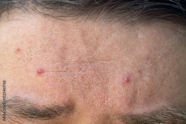 Obraz Skin problems. European male forehead with acne and pimples. Macro close up shot