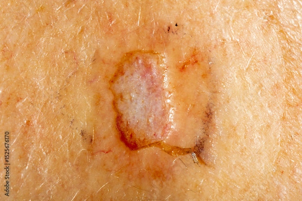 Fototapeta Close up of a skin biopsy site of a concerning lesion