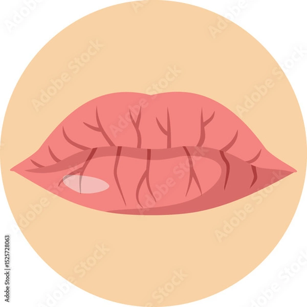 Fototapeta Dry and Cracked Lips Vector Concept Illustration. Cosmetic problem of dryness and dehydration of the mouth 
