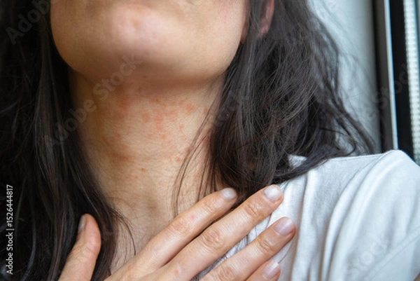 Fototapeta Close-up of a woman’s neck showing an allergic skin reaction with redness and irritation, likely due to eczema or atopic dermatitis. Captured indoors for dermatological reference
