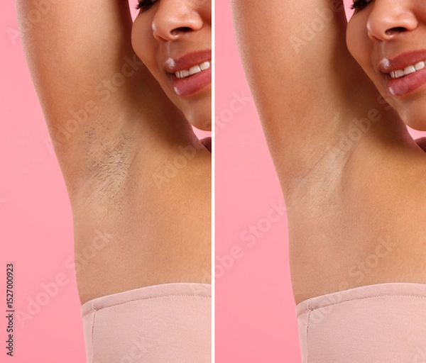 Obraz Before and after epilation. Woman showing armpit on pink background, closeup. Collage