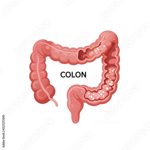Fototapeta Medical illustration showing healthy colon compared to colon cancer with labeled anatomical details.