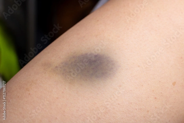 Fototapeta Closeup image of an arm showing a purple spot on it