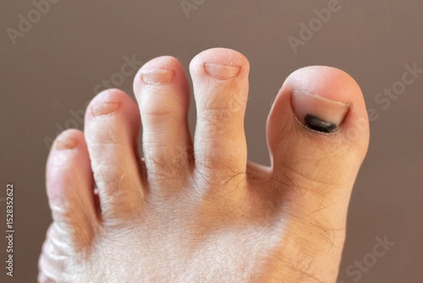 Obraz Close-up of a human foot with a bruise under the big toenail