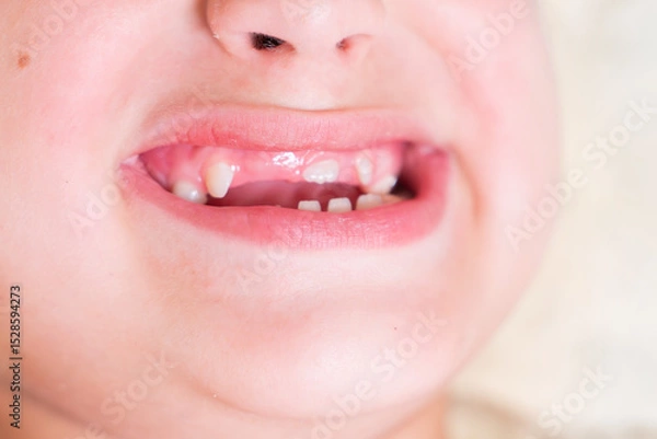 Fototapeta Close-up of Baby's First Teeth Coming Through Gums