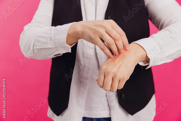 Obraz Woman scratching itchy red rash on wrist, concept of allergies and skin diseases
