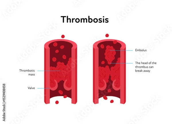 Obraz Deep vein thrombosis for healthcare infographic. Vector flat illustration with text label. Vascular disease diagnostic and treatment. Human healthy vein and DVT. Design for health care, education