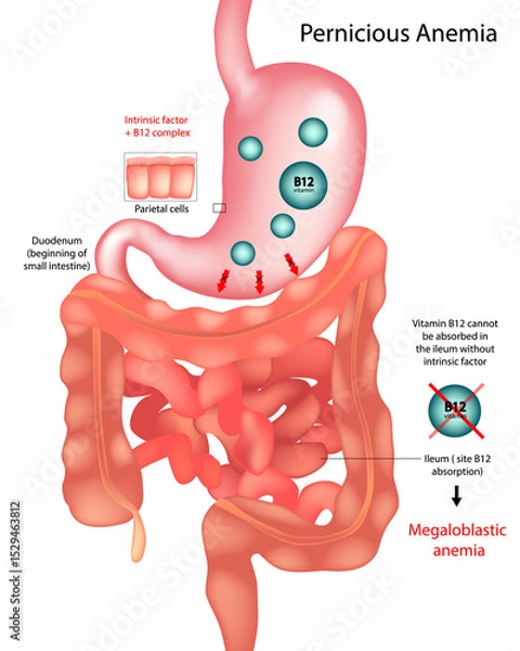 Obraz Educational medical illustration showing the mechanism of pernicious anemia. The diagram highlights the stomach's parietal cells that produce intrinsic factor, which is essential for vitamin B12 absor
