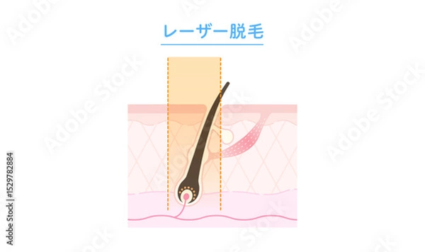 Obraz レーザー脱毛・医療脱毛のしくみ 断面図