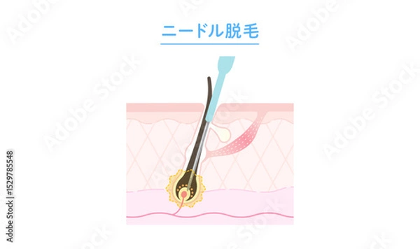 Fototapeta ニードル脱毛のしくみ 断面図