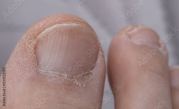 Obraz Dry neglected toenail with transverse longitudinal fissures close up
