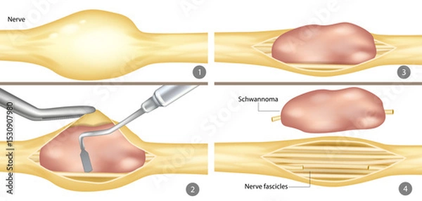 Obraz Surgical Removal of Schwannoma from Peripheral Nerve. Step-by-Step Illustration of Schwannoma Excision. Medical Diagram of Nerve Tumor Resection