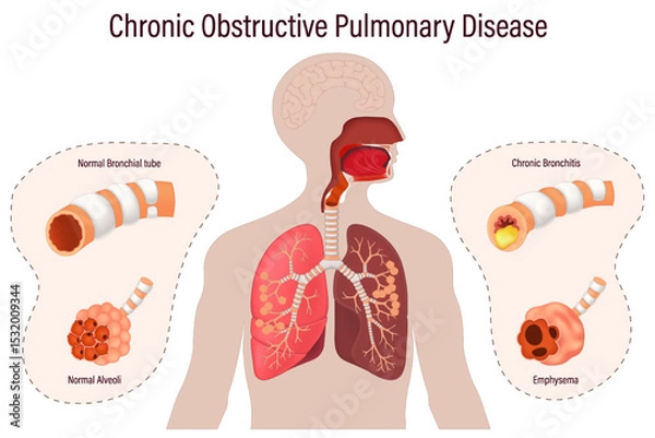 Fototapeta Chronic obstructive pulmonary disease (COPD). Comparison between normal bronchus and alveoli with bronchitis and emphysema. Human respiratory system.