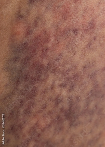 Fototapeta A person's leg has a bruise on it