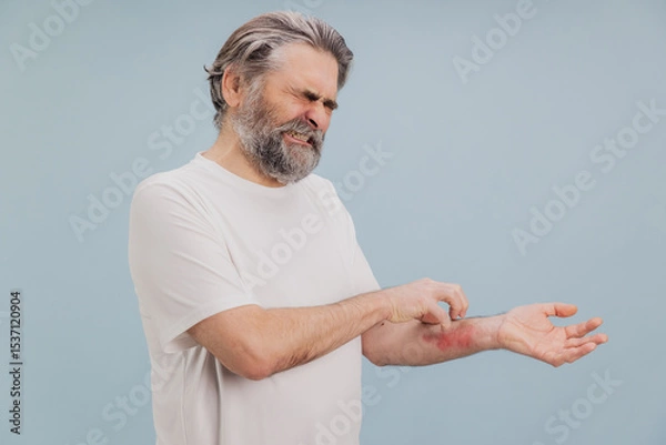 Obraz Senior man scratching itchy eczema on arm suffering from dermatitis